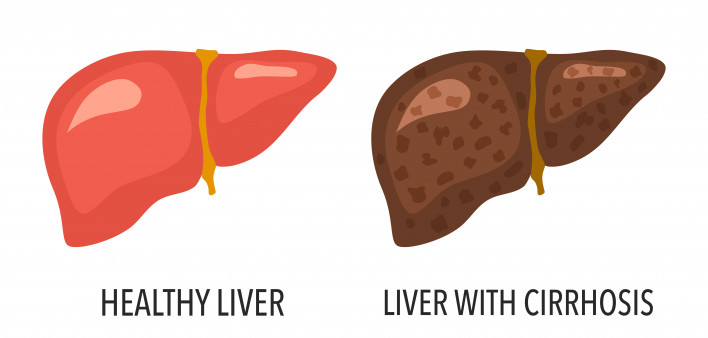 cirrhosis