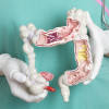 Colon cancer