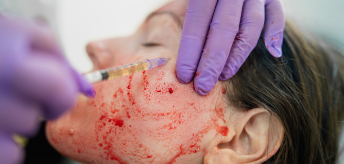 woman gets Revolutionary treatment of rejuvenation with blood plasma vampire facial