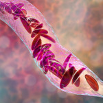 Sickle cell anemia