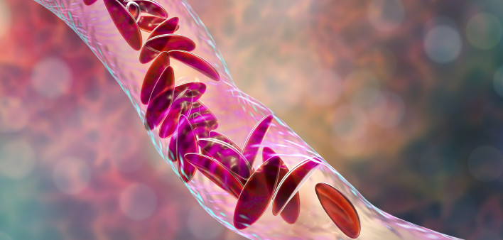Sickle cell anemia