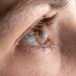 Macro eye photo. Keratoconus - eye disease, thinning of the cornea in the form of a cone.