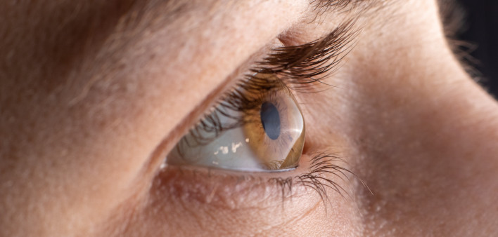 Macro eye photo. Keratoconus - eye disease, thinning of the cornea in the form of a cone.