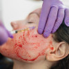 Vampire Facial