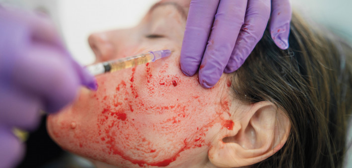 Vampire Facial