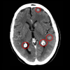 Lung cancers that are ALK-positive often spread to the brain (circled). In the CROWN trial, treatment with lorlatinib helped prevent new brain metastases.