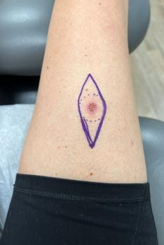 melanoma skin cancer MRA