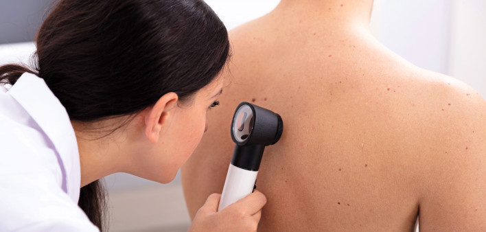 doctor looking for skin cancer melanoma