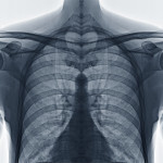 chest x ray
