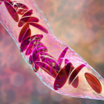 Sickle cell anemia