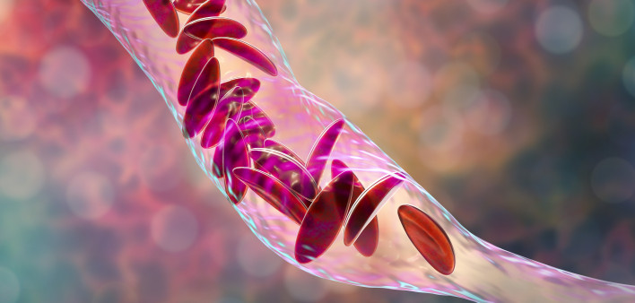 Sickle cell anemia