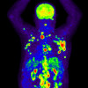 Imaging scan of a man with advanced Hodgkin lymphoma, showing multiple areas with cancer (red and yellow-orange).