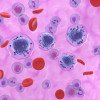 Acute myeloid leukemia (AML) cells, shown in purple, floating among other cells. AML is a type of blood cancer that starts in your bone marrow.