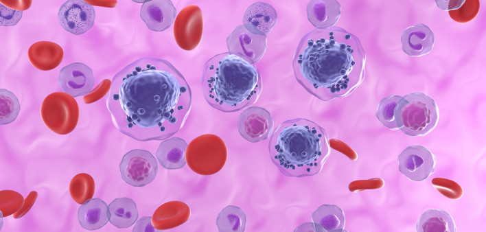 Acute myeloid leukemia AML blood cancer