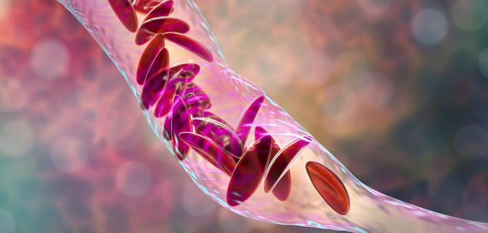 Sickle cell anemia