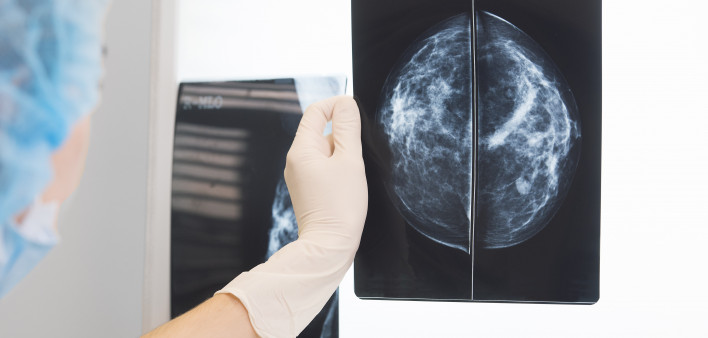 Woman doctor or nurse in surgery outfit is holding a mammogram in front of x-ray illuminator stock photo