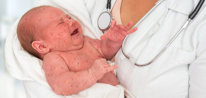 Doctor holding a newborn baby which is sick rubella or measles