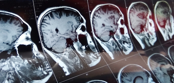 Magnetic resonance scan of the brain with skull.