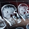 Magnetic resonance scan of the brain with skull.