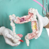 Colon cancer