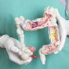 Colon cancer