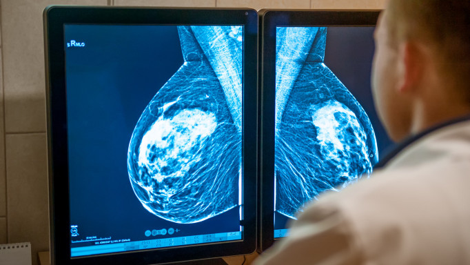 Photo about Doctor examines mammogram snapshot of breast of female patient on the monitors.