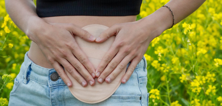unrecognizable woman lifestyle with an ostomy bag in spring. Colon cancer awareness