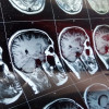 MRI scan of the brain with skull