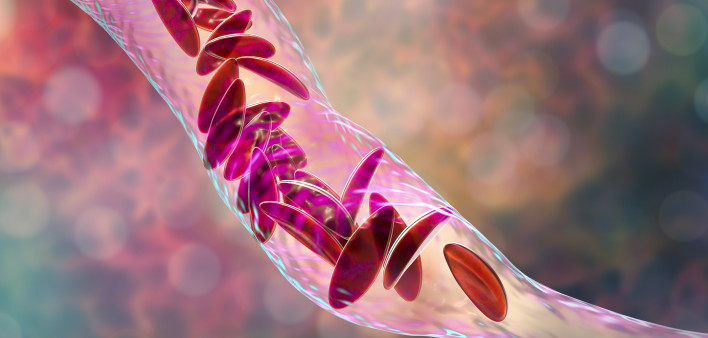 Sickle cell anemia