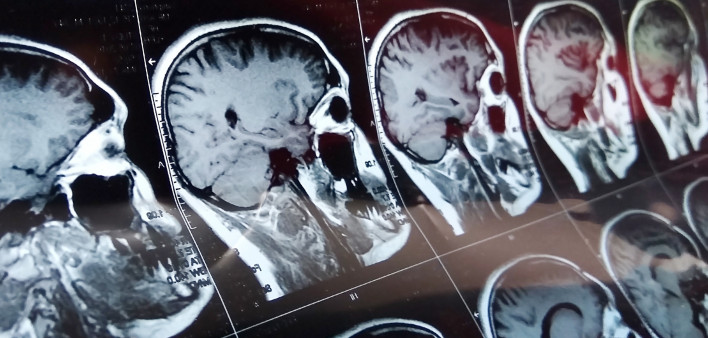Magnetic resonance scan of the brain with skull.