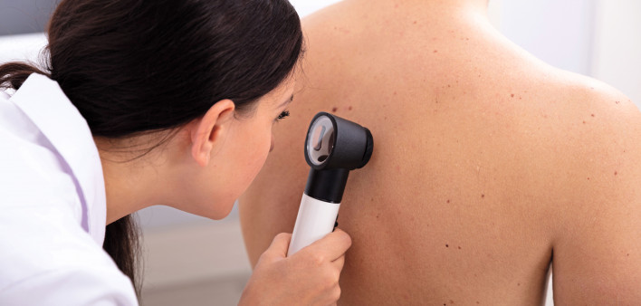 doctor looking for skin cancer melanoma
