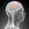 Brain cancer