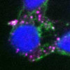 The SRC protein (pink) was found on the outside of cancer cells taken from a UCSF patient. DNA is shown in blue, structural proteins outside the cells are shown in green.