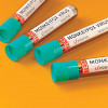 Vials with blood marked Monekypox