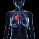 Illustration of woman with lung cancer