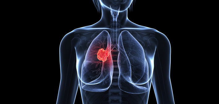 Illustration of woman with lung cancer