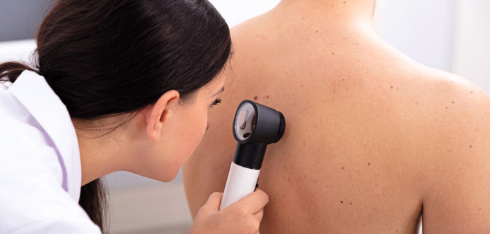 doctor looking for skin cancer melanoma