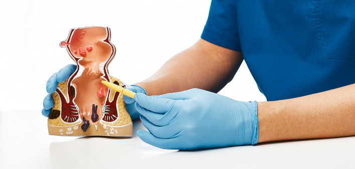 Proctologist pointing pen rectum pathologies on an anatomical model. Treatment of rectal diseases, hemorrhoidProctologist pointing pen rectum pathologies on an anatomical model. Treatment of rectal diseases, hemorrhoid