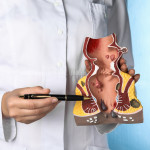 Doctor pointing at model of unhealthy lower rectum