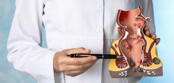 Doctor pointing at model of unhealthy lower rectum