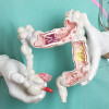 Colon cancer