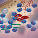 multiple myeloma