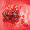 blood clot