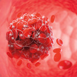 blood clot