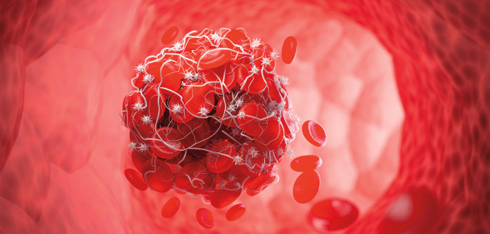 blood clot
