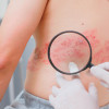 Shingles