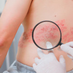 doc hand and magnifying glass examining Shingles