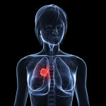 Illustration of woman with lung cancer