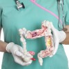 Colon cancer