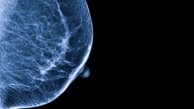 Mammogram image